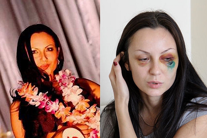 Первая красавица Первоуральска, жестоко избитая в баре в середине сентября, до сих пор проходит лечение